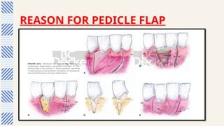 Pedicle Flaps Example Comprehensive Guide to Periodontal Plastic and Esthetic Surgery ...