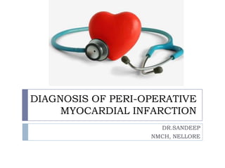 DIAGNOSIS OF PERI-OPERATIVE
MYOCARDIAL INFARCTION
DR.SANDEEP
NMCH, NELLORE
 