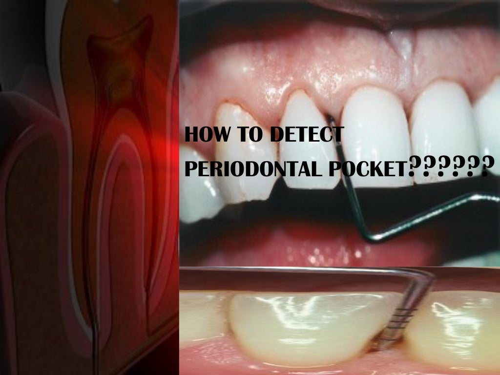 Periodontal pockets