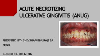 Comprehensive Overview and Treatment of Acute Necrotizing Ulcerative ...