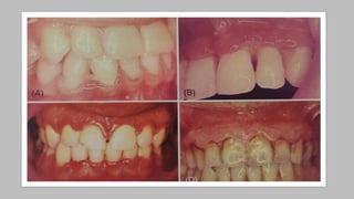 Comprehensive Overview and Treatment of Acute Necrotizing Ulcerative ...