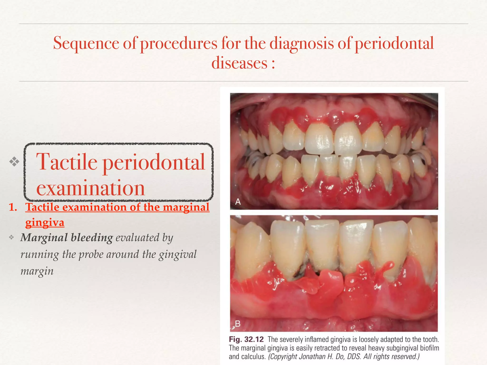 Sequence of procedures for the diagnosis of periodontal
diseases :
❖ Tactile periodontal
examination
1. Tactile examination of the marginal
gingiva
❖ Marginal bleeding evaluated by
running the probe around the gingival
margin
 