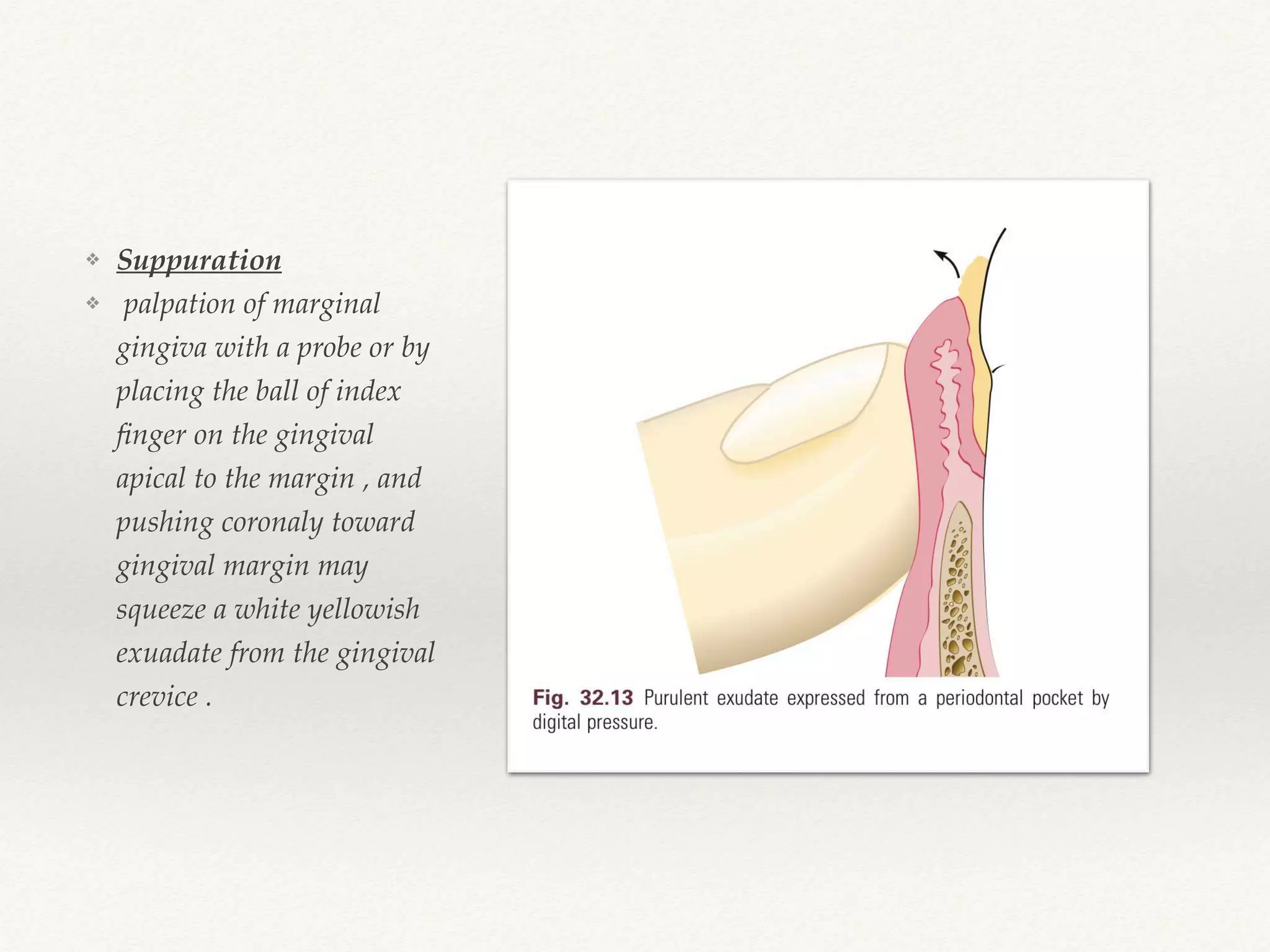❖ Suppuration
❖ palpation of marginal
gingiva with a probe or by
placing the ball of index
ﬁnger on the gingival
apical to the margin , and
pushing coronaly toward
gingival margin may
squeeze a white yellowish
exuadate from the gingival
crevice .
 