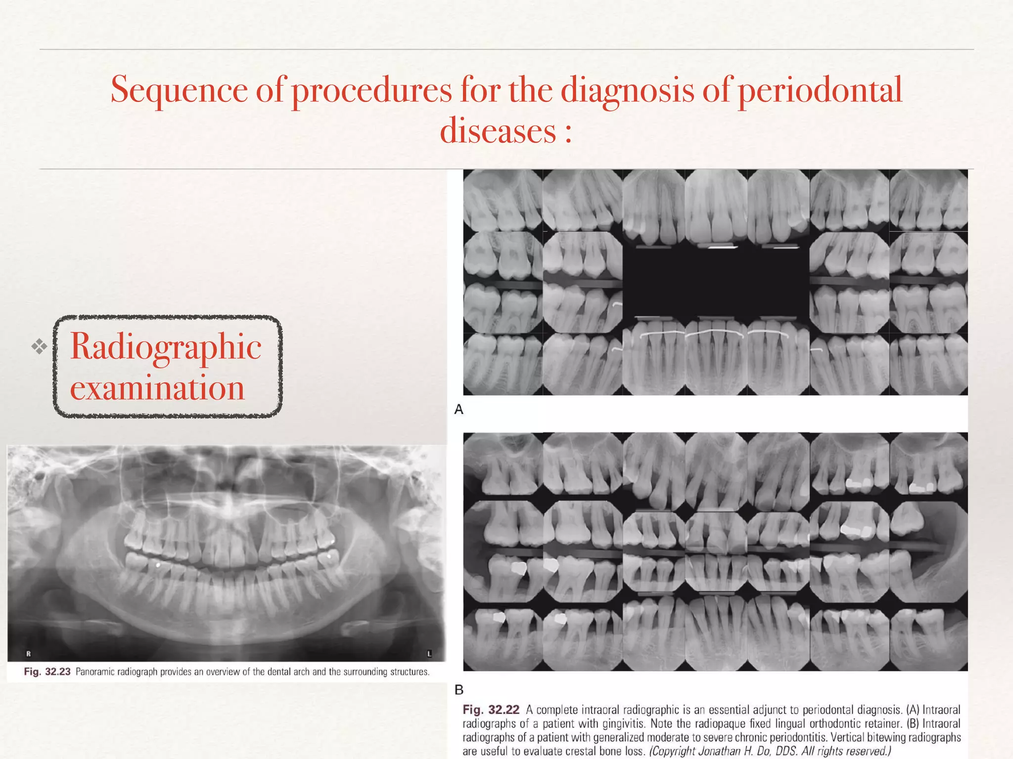 Sequence of procedures for the diagnosis of periodontal
diseases :
❖ Radiographic
examination
 