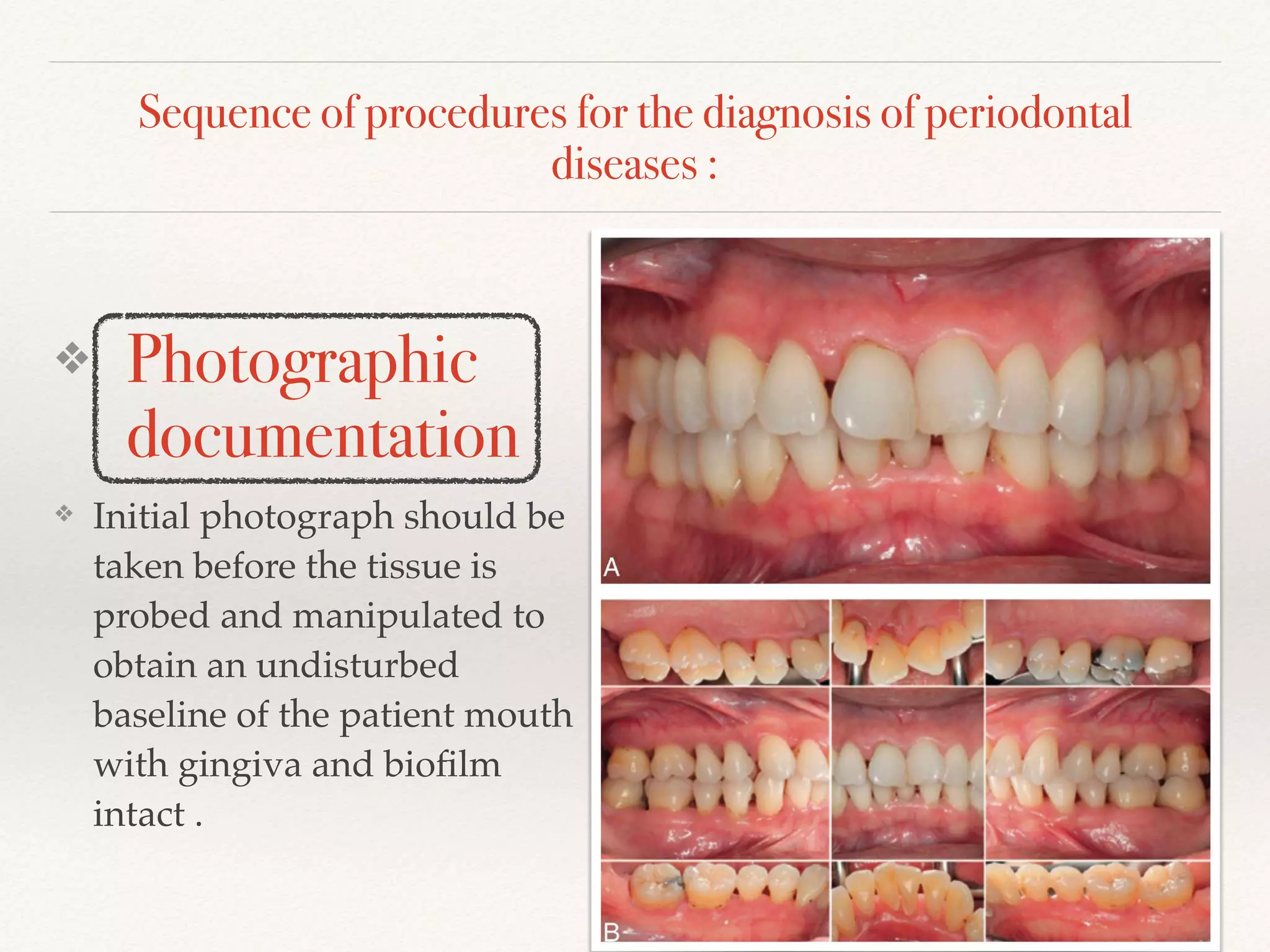 Sequence of procedures for the diagnosis of periodontal
diseases :
❖ Photographic
documentation
❖ Initial photograph should be
taken before the tissue is
probed and manipulated to
obtain an undisturbed
baseline of the patient mouth
with gingiva and bioﬁlm
intact .
 