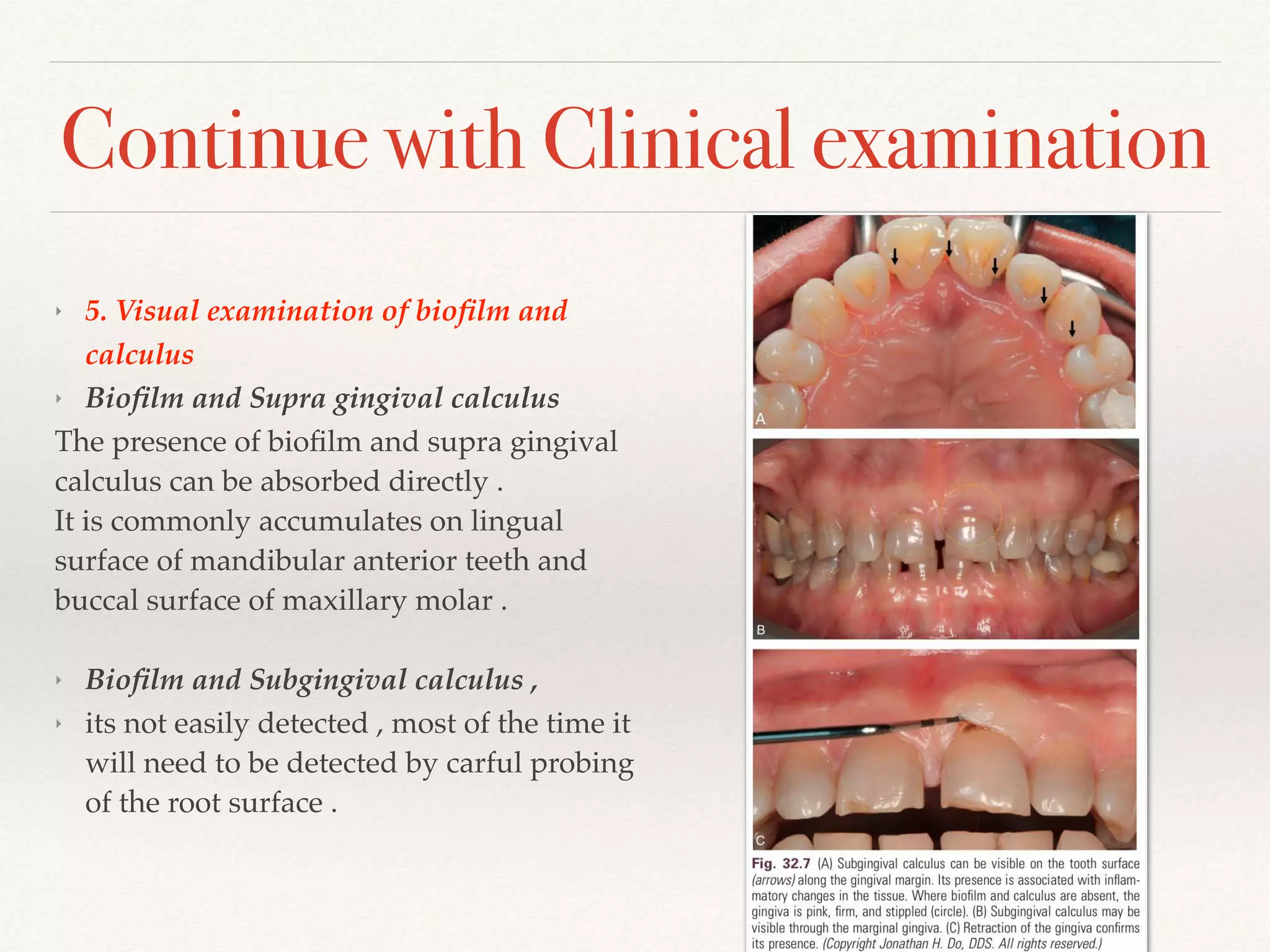 Continue with Clinical examination
‣ 5. Visual examination of bioﬁlm and
calculus
‣ Bioﬁlm and Supra gingival calculus
The presence of bioﬁlm and supra gingival
calculus can be absorbed directly .
It is commonly accumulates on lingual
surface of mandibular anterior teeth and
buccal surface of maxillary molar .
‣ Bioﬁlm and Subgingival calculus ,
‣ its not easily detected , most of the time it
will need to be detected by carful probing
of the root surface .
 
