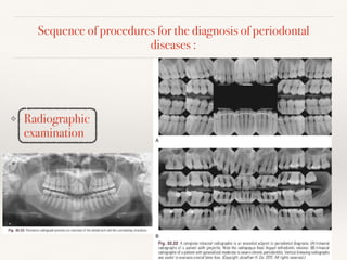 Sequence of procedures for the diagnosis of periodontal
diseases :
❖ Radiographic
examination
 