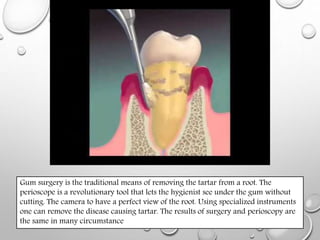 Perioscope | PPTX