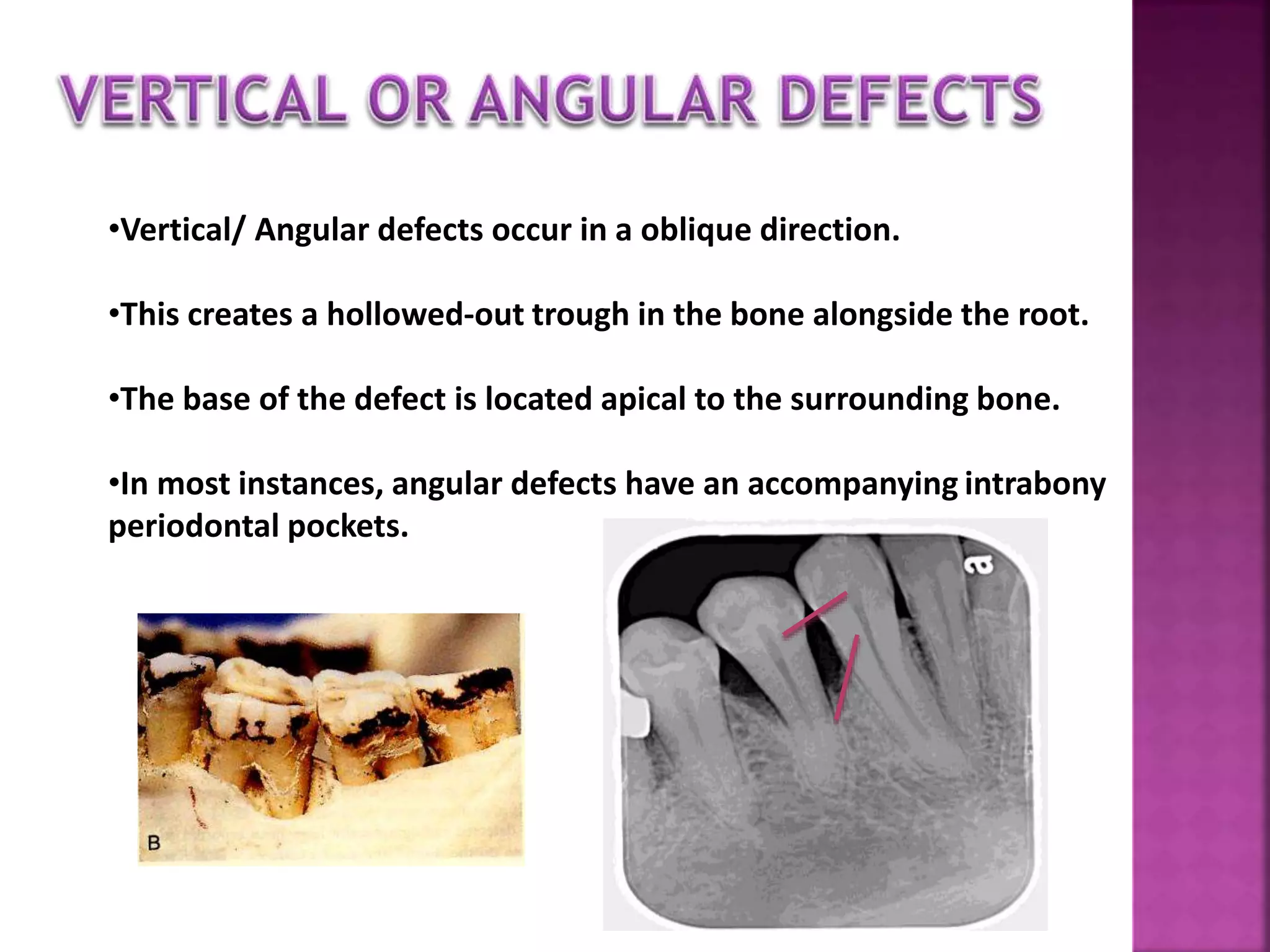 •Vertical/ Angular defects occur in a oblique direction.
•This creates a hollowed-out trough in the bone alongside the root.
•The base of the defect is located apical to the surrounding bone.
•In most instances, angular defects have an accompanying intrabony
periodontal pockets.
 