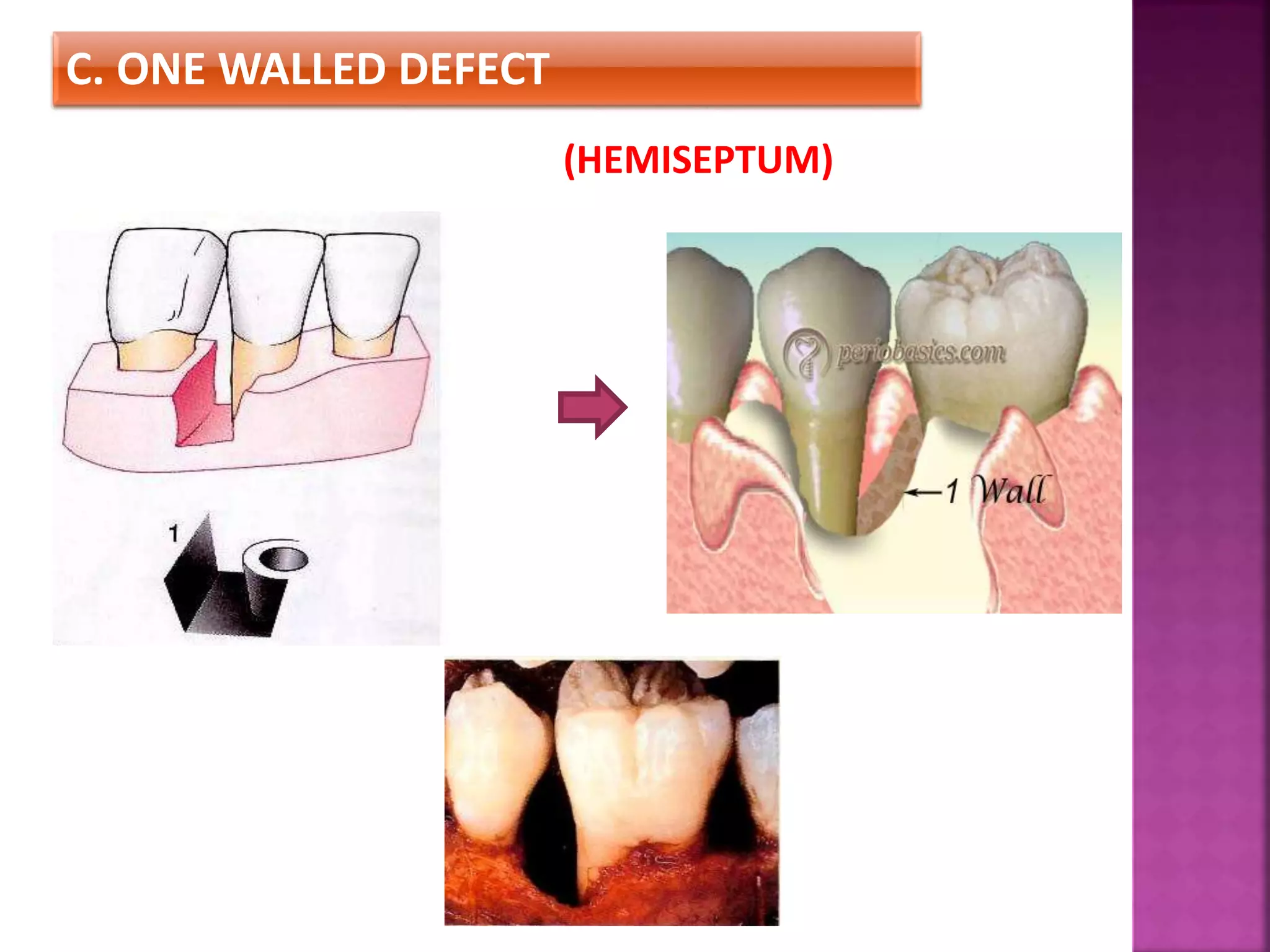 C. ONE WALLED DEFECT
(HEMISEPTUM)
 