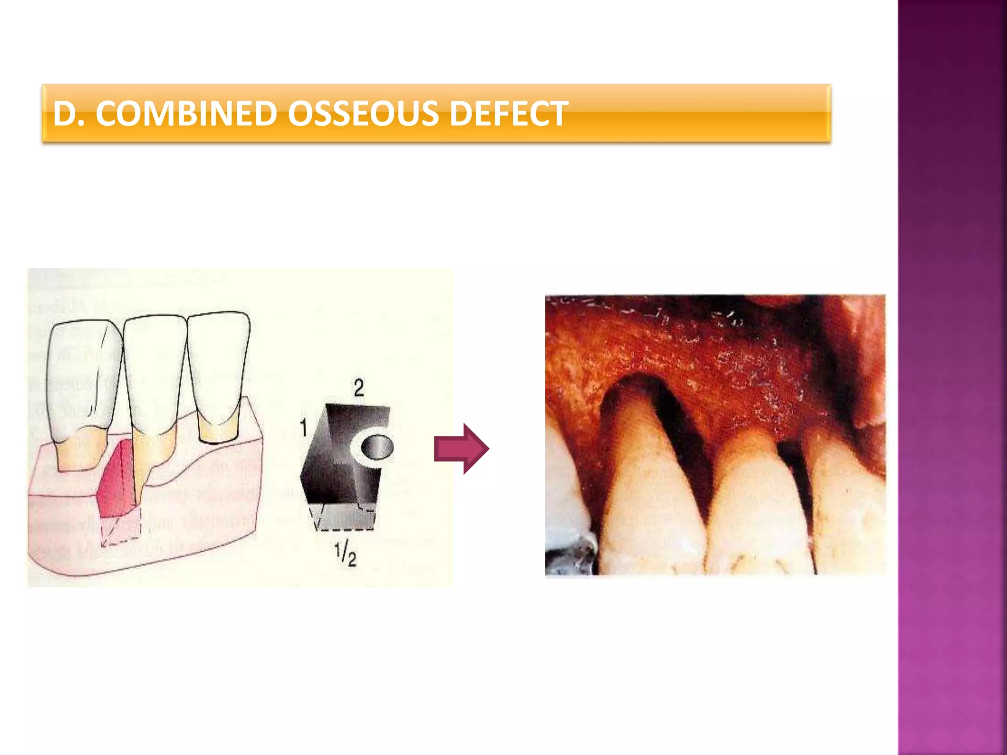 D. COMBINED OSSEOUS DEFECT
 