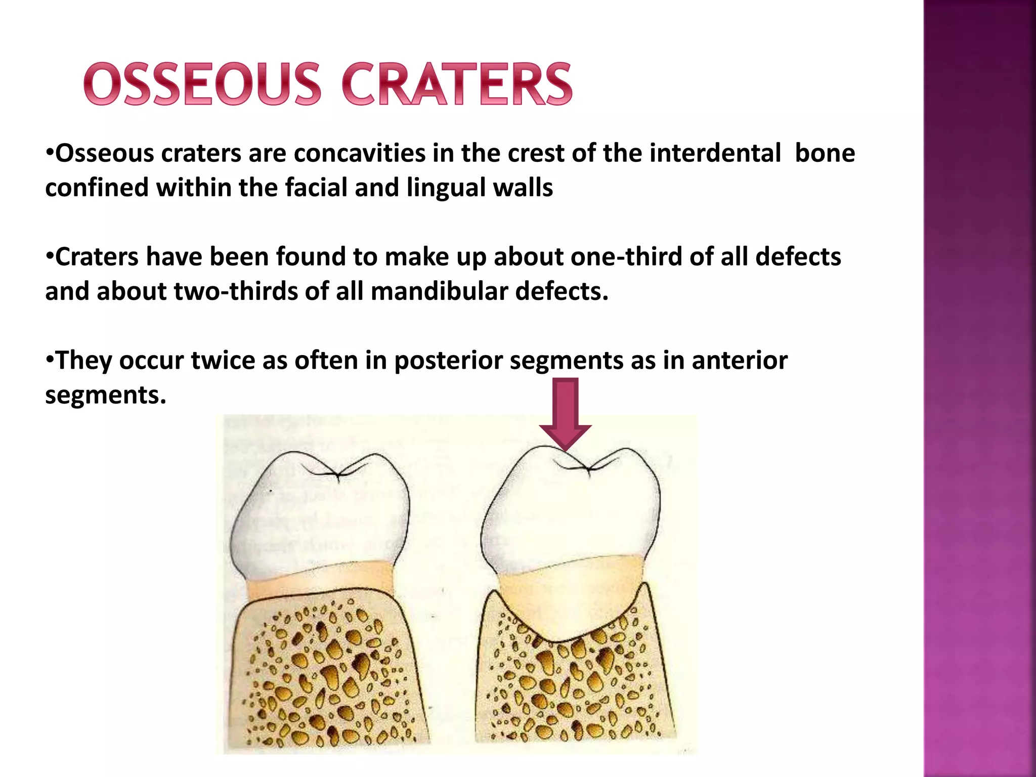 •Osseous craters are concavities in the crest of the interdental bone
confined within the facial and lingual walls
•Craters have been found to make up about one-third of all defects
and about two-thirds of all mandibular defects.
•They occur twice as often in posterior segments as in anterior
segments.
 