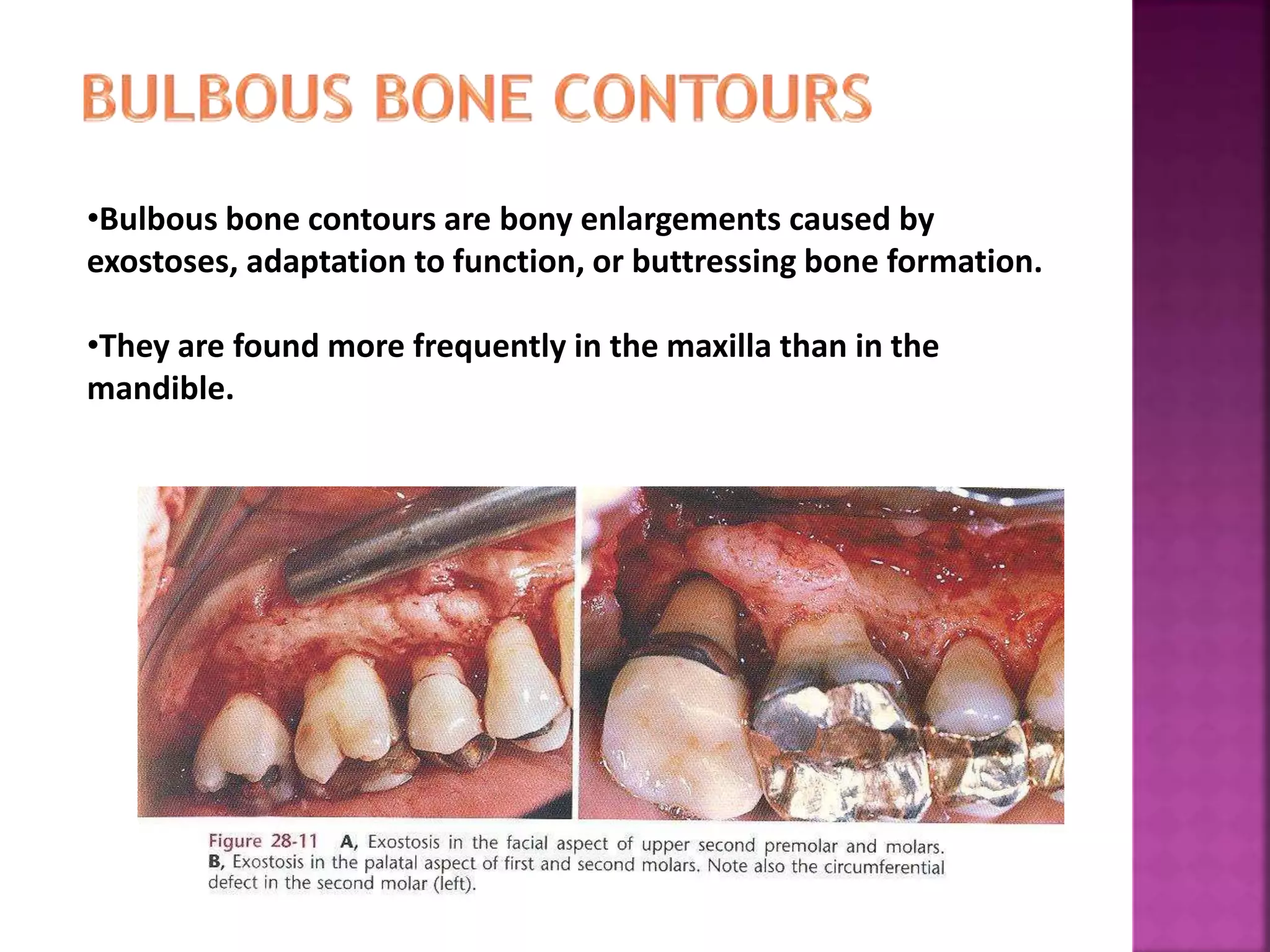 •Bulbous bone contours are bony enlargements caused by
exostoses, adaptation to function, or buttressing bone formation.
•They are found more frequently in the maxilla than in the
mandible.
 