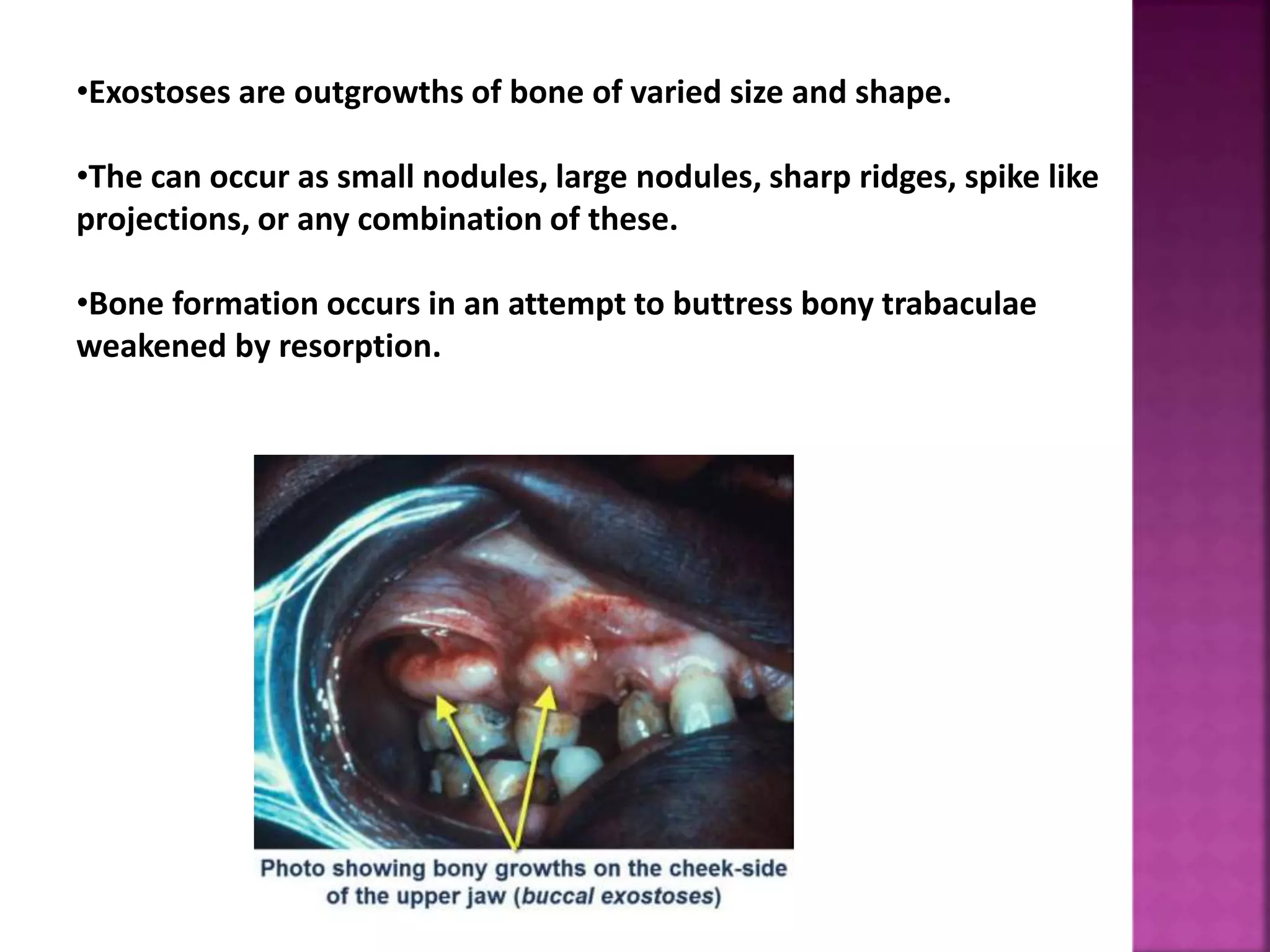 •Exostoses are outgrowths of bone of varied size and shape.
•The can occur as small nodules, large nodules, sharp ridges, spike like
projections, or any combination of these.
•Bone formation occurs in an attempt to buttress bony trabaculae
weakened by resorption.
 