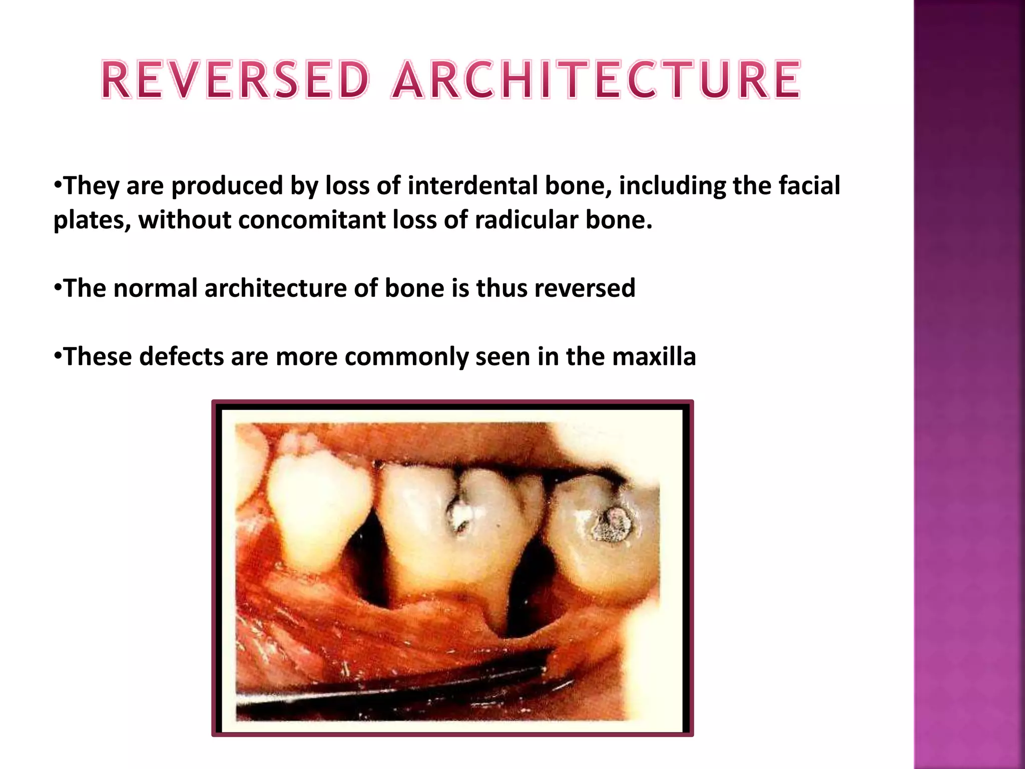 •They are produced by loss of interdental bone, including the facial
plates, without concomitant loss of radicular bone.
•The normal architecture of bone is thus reversed
•These defects are more commonly seen in the maxilla
 