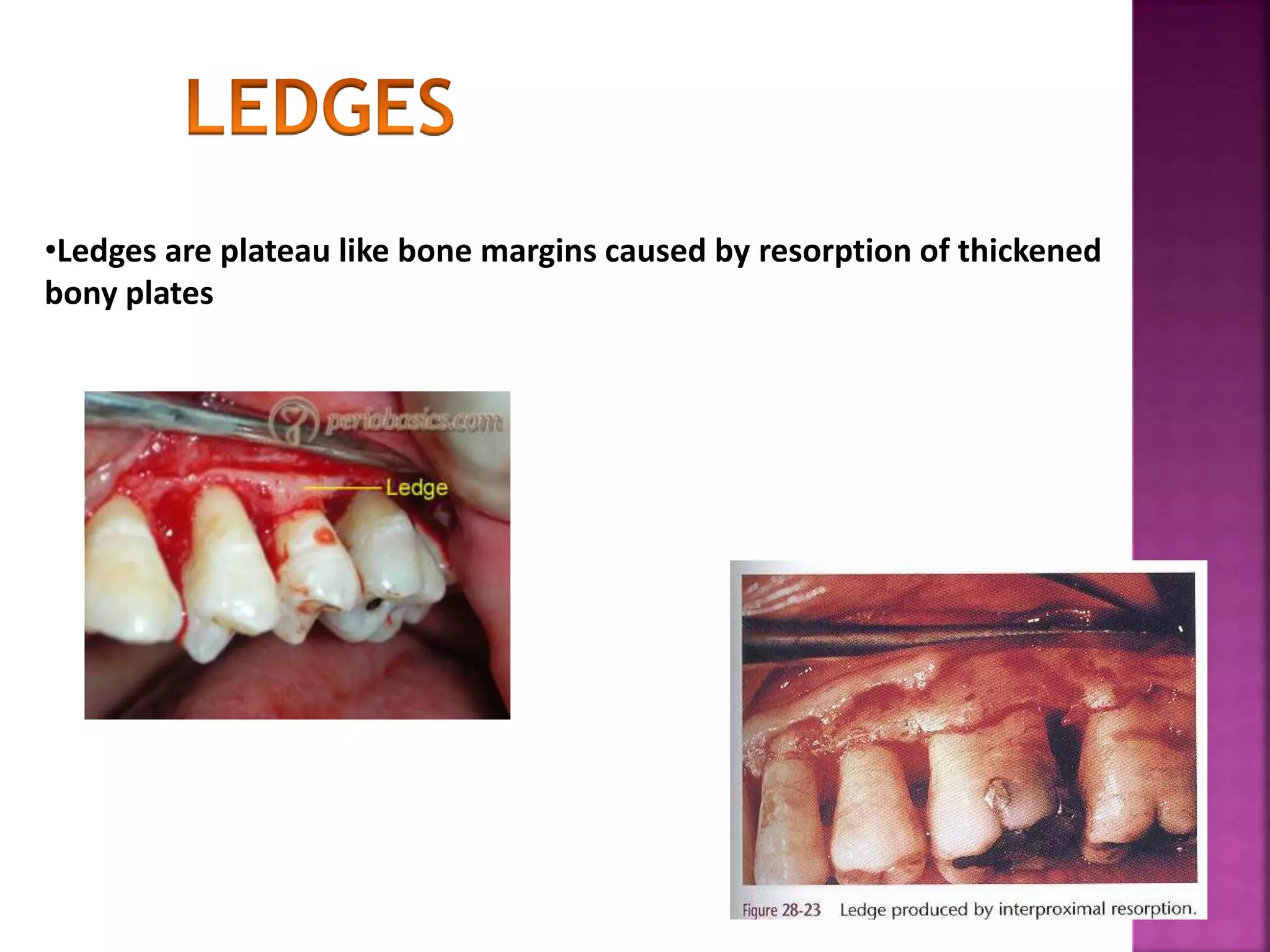 •Ledges are plateau like bone margins caused by resorption of thickened
bony plates
 