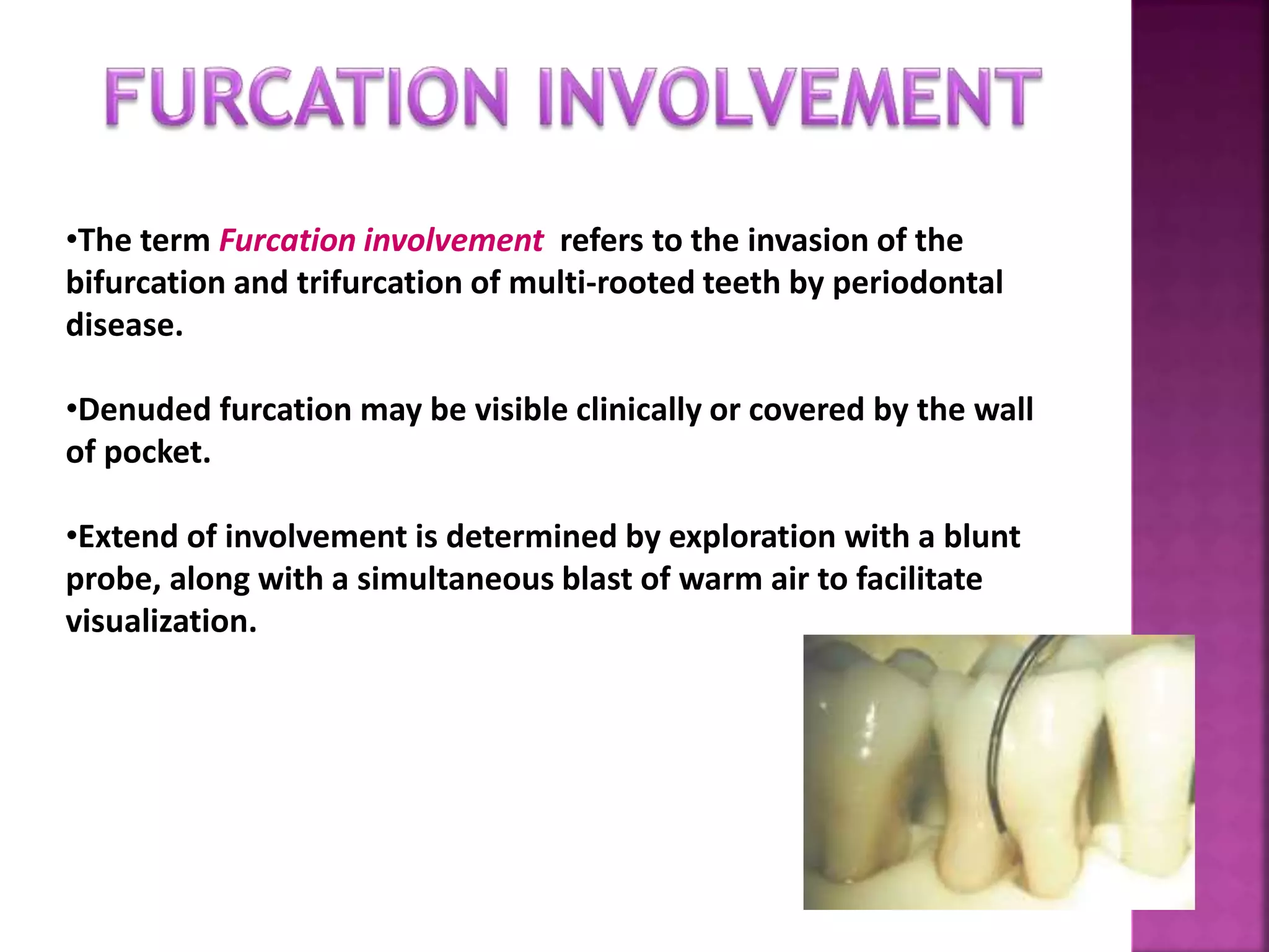 •The term Furcation involvement refers to the invasion of the
bifurcation and trifurcation of multi-rooted teeth by periodontal
disease.
•Denuded furcation may be visible clinically or covered by the wall
of pocket.
•Extend of involvement is determined by exploration with a blunt
probe, along with a simultaneous blast of warm air to facilitate
visualization.
 