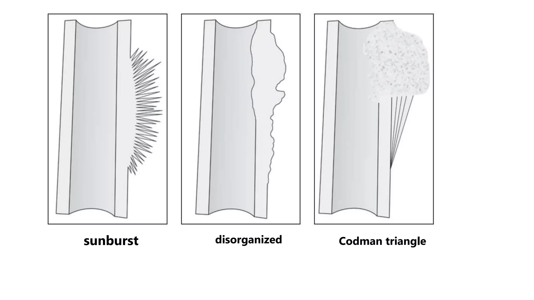 Periosteal reaction | PPTX