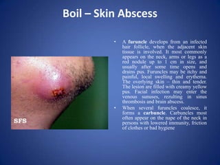 Carbuncle Bad Periostitis | PPTX