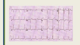 Peripartum cardiomyopathy | PPTX