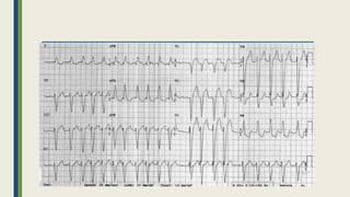 Peripartum cardiomyopathy | PPTX