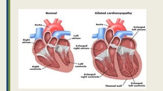 Peripartum cardiomyopathy | PPTX