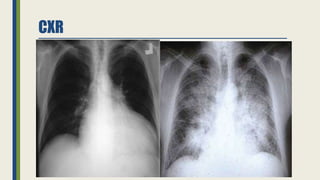 Peripartum cardiomyopathy | PPTX