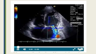 Peripartum cardiomyopathy | PPTX