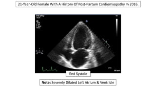 21-Year-Old Female With A History Of Post-Partum Cardiomyopathy In 2016.
Note: Severely Dilated Left Atrium & Ventricle
En...