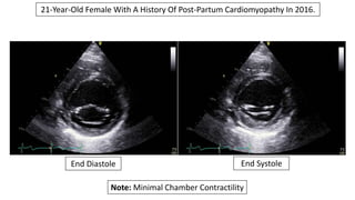 21-Year-Old Female With A History Of Post-Partum Cardiomyopathy In 2016.
End Diastole End Systole
Note: Minimal Chamber Co...