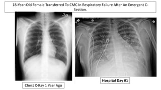 18-Year-Old Female Transferred To CMC In Respiratory Failure After An Emergent C-
Section.
Chest X-Ray 1 Year Ago
Hospital...