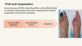 Peripheral-Arterial-Disease (1).pptx explanation | PPTX