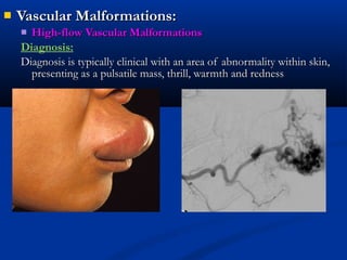  Vascular Malformations:Vascular Malformations:
 High-flow Vascular MalformationsHigh-flow Vascular Malformations
Diagnosis:
Diagnosis is typically clinical with an area of abnormality within skin,Diagnosis is typically clinical with an area of abnormality within skin,
presenting as a pulsatile mass, thrill, warmth and rednesspresenting as a pulsatile mass, thrill, warmth and redness
 