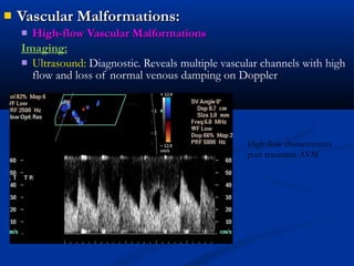  Vascular Malformations:Vascular Malformations:
 High-flow Vascular MalformationsHigh-flow Vascular Malformations
Imaging:
 Ultrasound: Diagnostic. Reveals multiple vascular channels with high
flow and loss of normal venous damping on Doppler
hhhhhh
High flow characteristics
post traumatic AVM
 