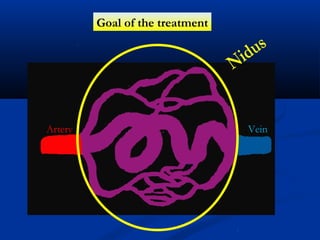 Goal of the treatment
Artery Vein
 