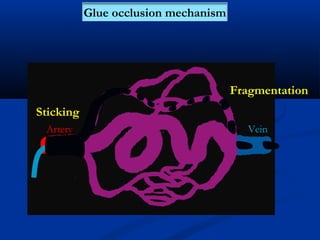 Artery Vein
Sticking
Fragmentation
Glue occlusion mechanism
 