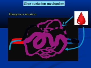 Dangerous situation
Glue occlusion mechanism
 
