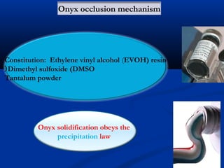 Constitution: Ethylene vinyl alcohol (EVOH) resin
Dimethyl sulfoxide (DMSO(
Tantalum powder
Onyx solidification obeys the
precipitation law
Onyx occlusion mechanism
 