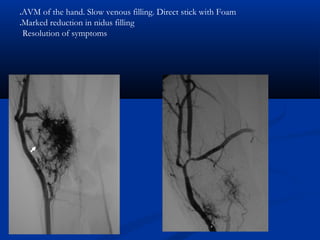 AVM of the hand. Slow venous filling. Direct stick with Foam.
Marked reduction in nidus filling.
Resolution of symptoms
 