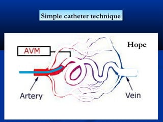 Simple catheter techniqueSimple catheter technique
Hope
 