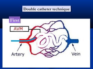 Double catheter techniqueDouble catheter technique
FirstFirst
 