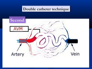 Double catheter techniqueDouble catheter technique
SecondSecond
 