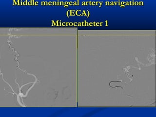 Middle meningeal artery navigationMiddle meningeal artery navigation
(ECA)(ECA)
Microcatheter 1Microcatheter 1
 