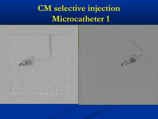 CM selective injection
Microcatheter 1
 