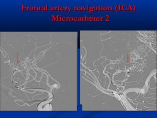 Frontal artery navigation (ICA)Frontal artery navigation (ICA)
Microcatheter 2Microcatheter 2
 