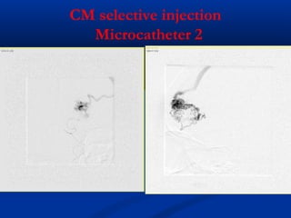 CM selective injection
Microcatheter 2
 