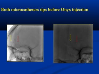 Both microcatheters tips before Onyx injectionBoth microcatheters tips before Onyx injection
 
