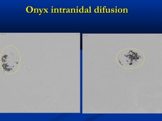 Onyx intranidal difusionOnyx intranidal difusion
veine veine
 