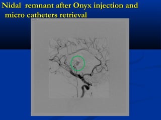 Nidal remnant after Onyx injection andNidal remnant after Onyx injection and
micro catheters retrievalmicro catheters retrieval
 