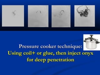 Pressure cooker technique:Pressure cooker technique:
Using coil+ or glue, then inject onyxUsing coil+ or glue, then inject onyx
for deep penetrationfor deep penetration
 
